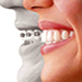 ortodoncia-lima-brackets
